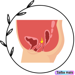 fisioterapia pélvica no prolapso pélvico